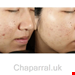  کنترل چربی انواع پوست 30 میل مورد آمریکا Murad Blemish Control InvisiScar Resurfacing Treatment 30 ml